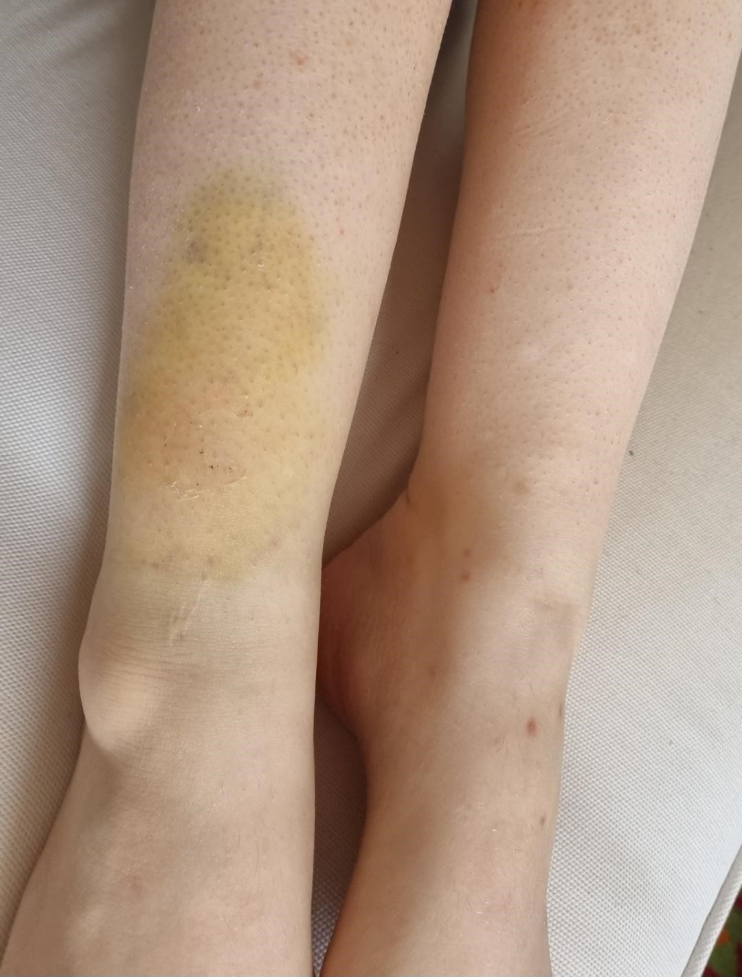 bruise